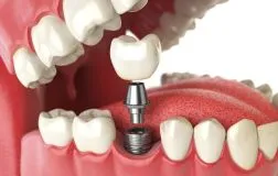 Dental Implants for Lasting Solutions